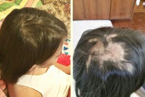 女児の頭髪が突然脱毛　母子で修煉に専念して回復