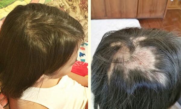 女児の頭髪が突然脱毛　母子で修煉に専念して回復