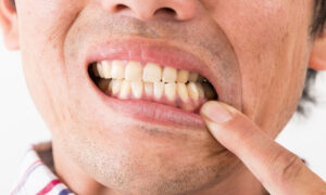 歯ぎしりを引き起こす3種類の要因