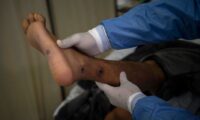 中国でのサル痘患者数が急増 　実態はさらに深刻か