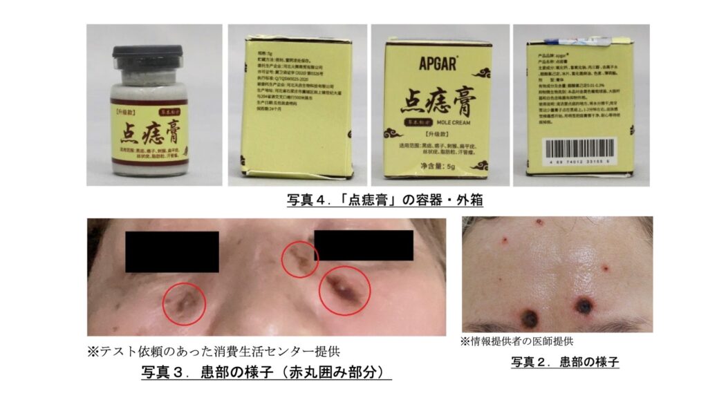 「シミ消し」中国製クリーム、実際は強アルカリ性…「塗ったらビリビリ痛み」