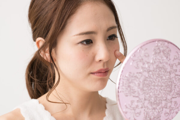 顔にシミができる多くの原因漢方医が教える症状に応じてシミを消す方法（2）