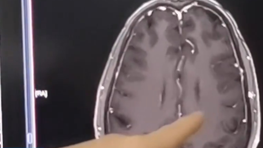 「体に良い」と信じて「豚の生の血」を飲みつづけ、脳に寄生虫＝中国雲南省