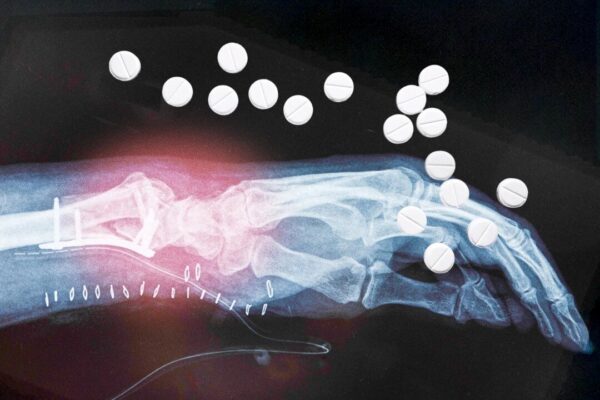 短期間のホルモン補充療法で骨折リスクが上昇か