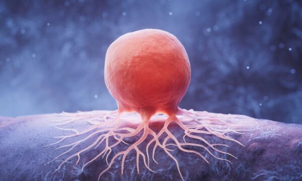 がんは遺伝だけではない：これらの主要な要因にご注意