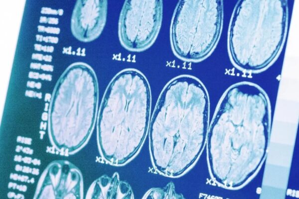 「沈黙のキラー」高血圧が招く脳の老化、その対策とは