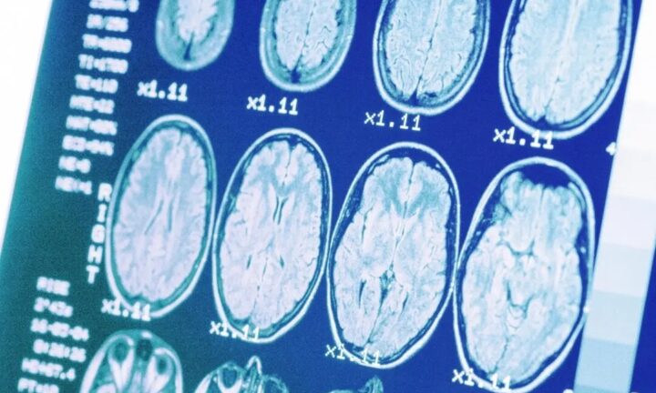 「沈黙のキラー」高血圧が招く脳の老化、その対策とは