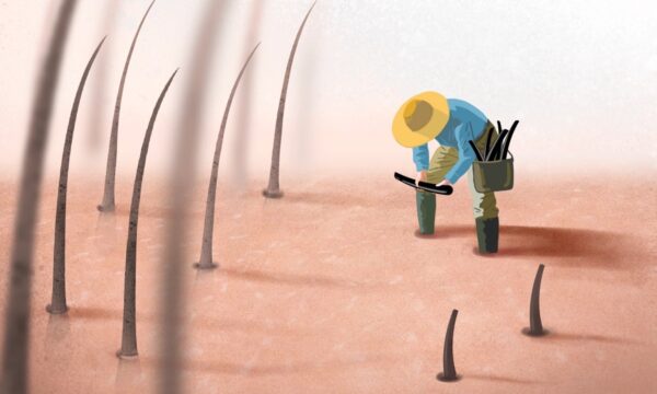 毛髪移植で後悔しないために——知っておくべき5つの事実