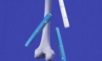 体重減少薬が骨の健康リスクに関連　5年間のデータで判明