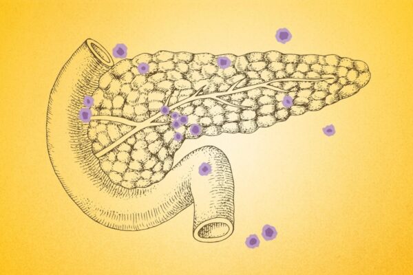 膵臓がんに注意：見落としがちな7つの警告サイン